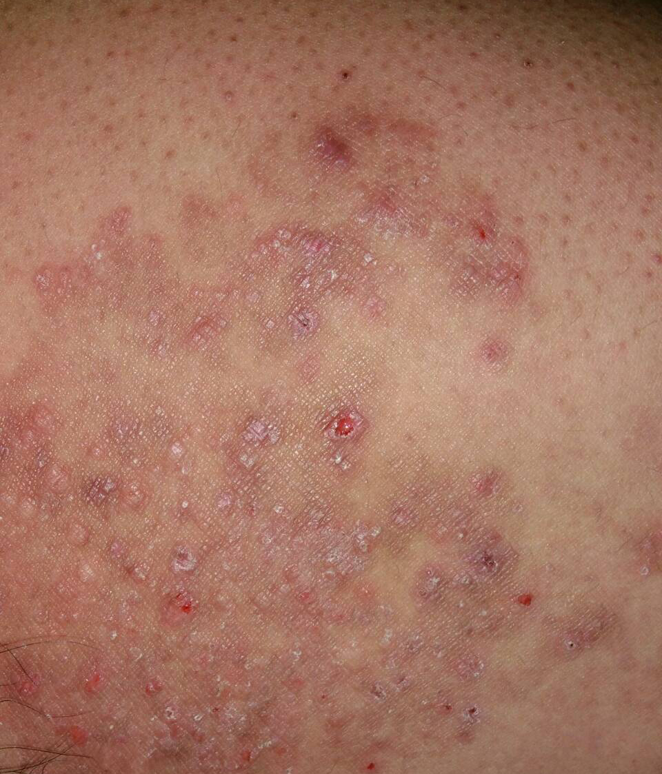 皮肤病的治疗