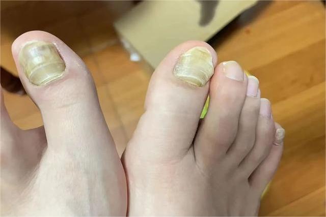 灰指甲属于皮肤癣病 灰指甲属于皮肤科的哪一类