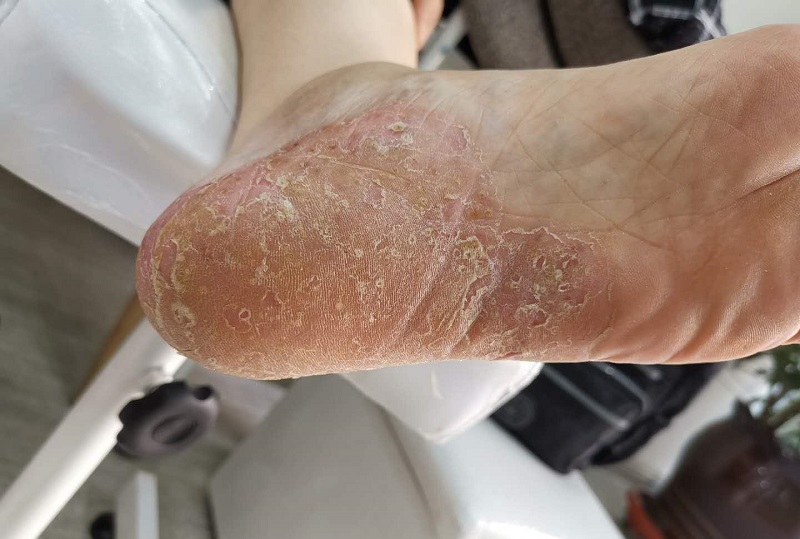 脚气怎么治疗能除根脚气怎么治疗能除根最快