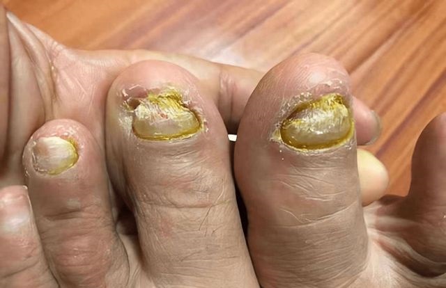 灰指甲怎么治疗最快最好方法 灰指甲怎么治好的最快