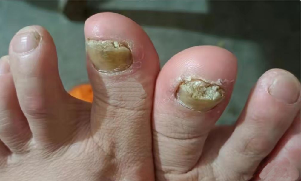 灰指甲是什么原因造成的 脚的灰指甲是什么原因造成的