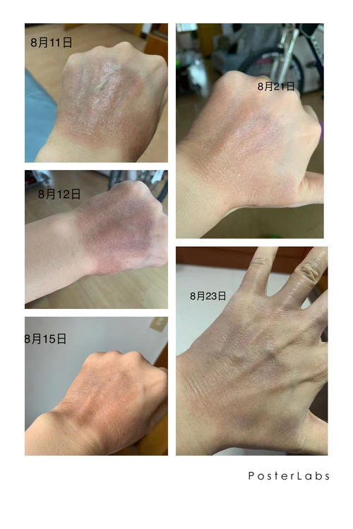 鼻梁上起痘痘怎么办 鼻梁上起痘痘怎么办