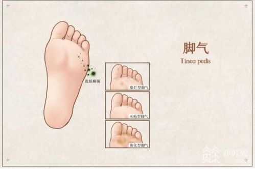 灰指甲的诊断方法 灰指甲的诊断方法