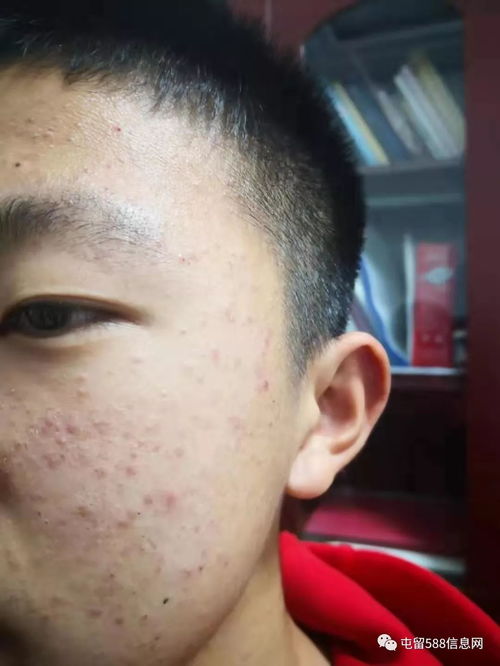 背部荨麻疹的预防方法 背部荨麻疹的预防方法