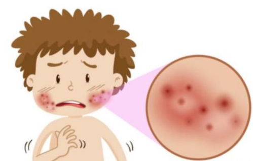 杭州激光治疗痤疮的费用是多少 杭州激光治疗痤疮的费用是多少