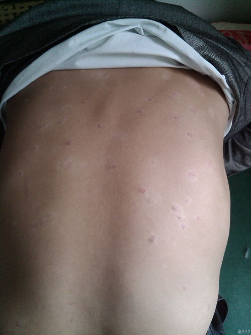 怎么知道激素脸在好转湿疹 怎么知道激素脸在好转湿疹