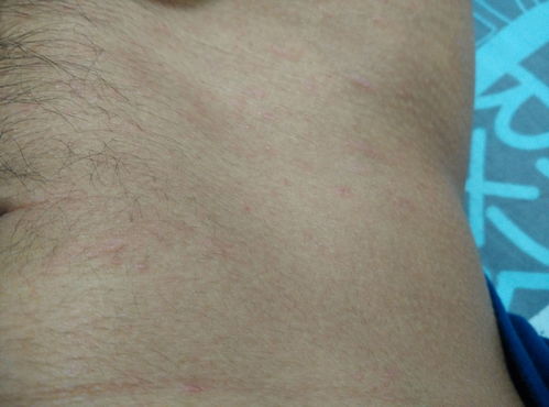 治疗湿疹医院上海哪家好 治疗湿疹医院上海哪家好