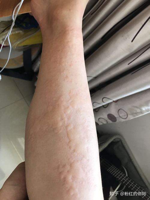 乳头湿疹是什么原因引起的 乳头湿疹是什么原因引起的