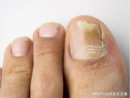 你是否哪些原因会导致灰指甲呢 你是否哪些原因会导致灰指甲呢