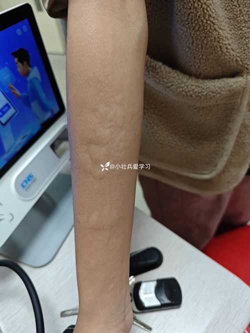 慢性荨麻疹不治的后果 慢性荨麻疹不治的后果