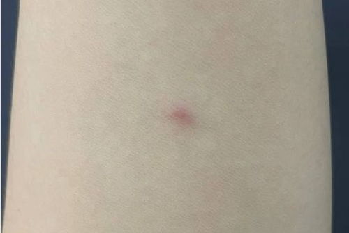 肾结石引起的腰痛怎么缓解 肾结石引起的腰痛怎么缓解