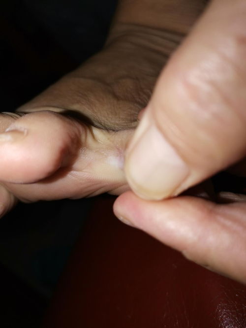 慢性荨麻疹怎么诊治较好呢 慢性荨麻疹怎么诊治较好呢