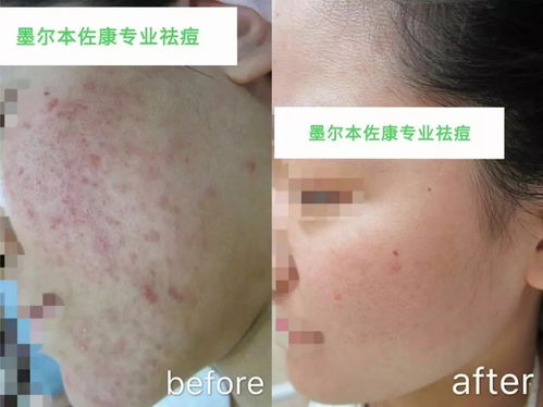 牛皮癣会长在脸上吗 牛皮癣会长在脸上吗