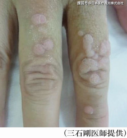 激素药物对牛皮癣都有哪些作用 激素药物对牛皮癣都有哪些作用