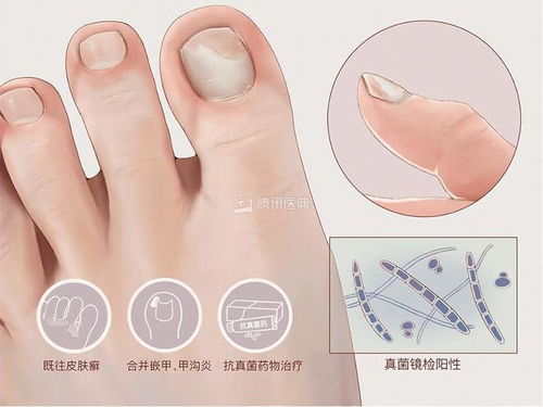 灰指甲有哪些特征情况 灰指甲有哪些特征情况