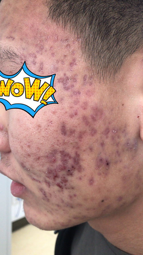 荨麻疹引起的原因 荨麻疹引起的原因