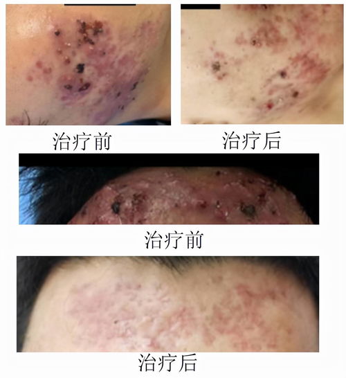 灰指甲用什么药最有效 灰指甲用什么药最有效