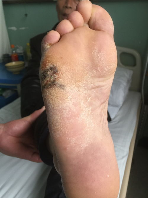 灰指甲有何危害呢 灰指甲有何危害呢