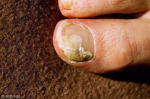 脚气现象最新观察报告年趋势分析与综合应对方案 脚气现象最新观察报告年趋势分析与综合应对方案