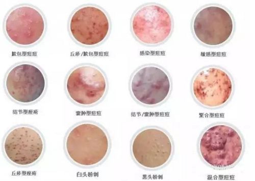 引发脓疱型牛皮癣原因 引发脓疱型牛皮癣原因