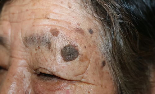 灰指甲什么症状有什么危害 灰指甲什么症状有什么危害