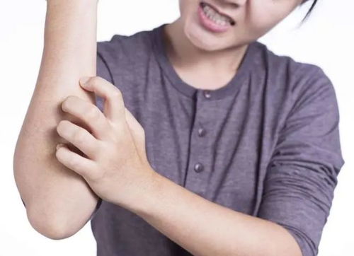 治疗灰指甲可以用外用疗法 治疗灰指甲可以用外用疗法