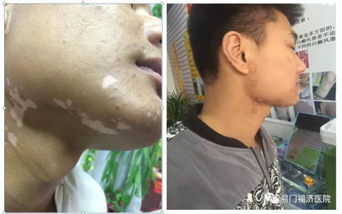 荨麻疹在发作时都有哪些症状出现 荨麻疹在发作时都有哪些症状出现