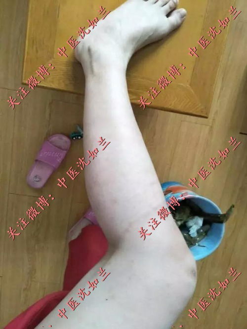 生活中灰指甲有什么症状 生活中灰指甲有什么症状