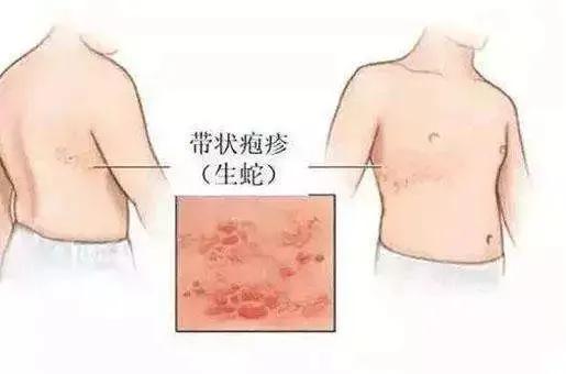 胆碱能性荨麻疹会自己好吗 胆碱能性荨麻疹会自己好吗