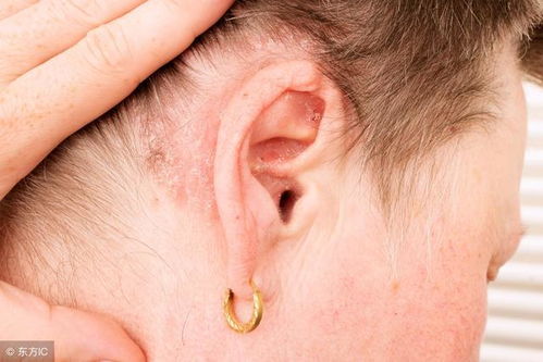 牛皮癣预防的五个方面 牛皮癣预防的五个方面