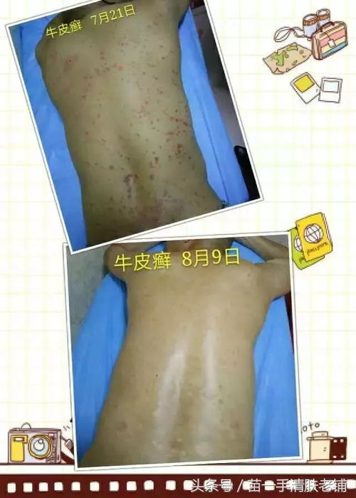 痤疮的原因包括哪些 痤疮的原因包括哪些