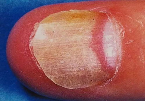 去痤疮疤痕 去痤疮疤痕