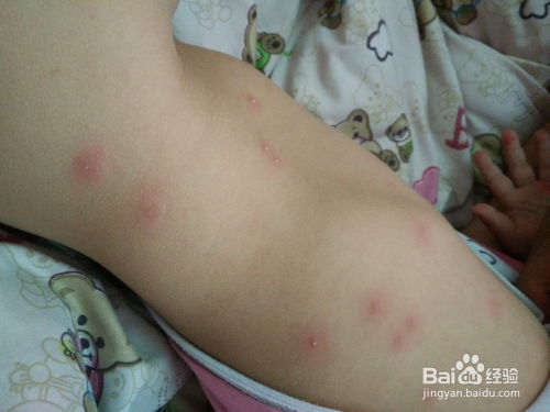 囊肿型痤疮能治好吗 囊肿型痤疮能治好吗