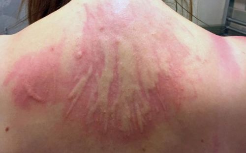 儿童荨麻疹怎么产生的 儿童荨麻疹怎么产生的