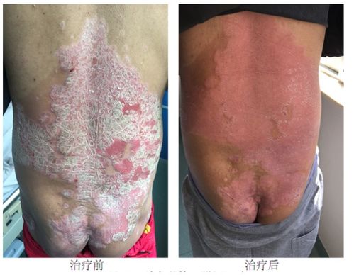 灰指甲有哪些症状表现 灰指甲有哪些危害 灰指甲有哪些症状表现 灰指甲有哪些危害