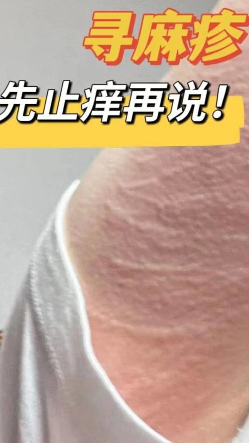 治疗灰指甲试试凤仙花 治疗灰指甲试试凤仙花