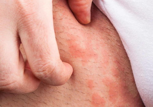 失眠了怎么治疗灰指甲图片 失眠了怎么治疗灰指甲图片