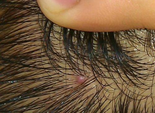 脸上痤疮怎么治(脸上长痤疮怎么治疗) 脸上痤疮怎么治(脸上长痤疮怎么治疗)