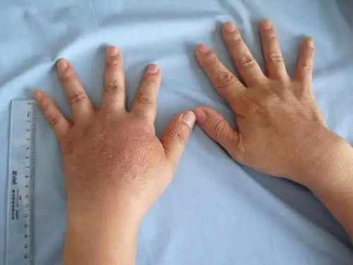 灰指甲是怎么患上的 灰指甲是怎么患上的