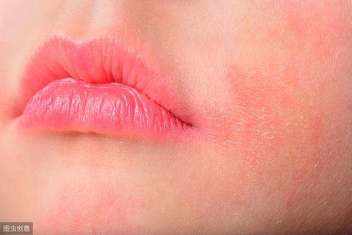 肛门周边湿疹治疗新方法 护理与用药建议 肛门周边湿疹治疗新方法 护理与用药建议