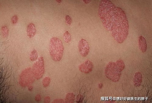 灰指甲的四大致病原因 灰指甲的四大致病原因