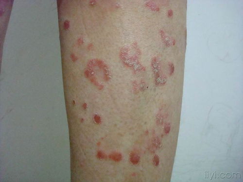 湿疹患者都有哪些不一样的症状 湿疹患者都有哪些不一样的症状