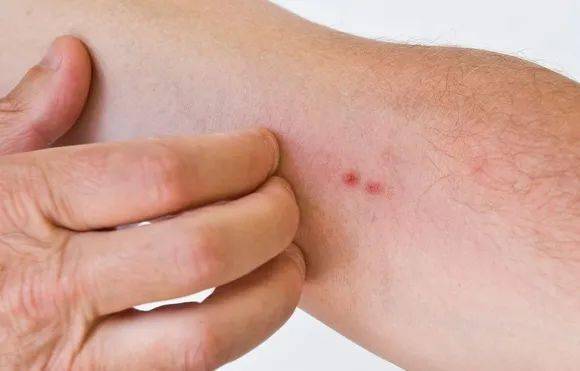 预防灰指甲的措施有哪些 预防灰指甲要注意消除诱发因素 预防灰指甲的措施有哪些 预防灰指甲要注意消除诱发因素