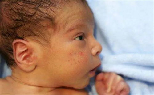 荨麻疹应怎么办呢 荨麻疹应怎么办呢
