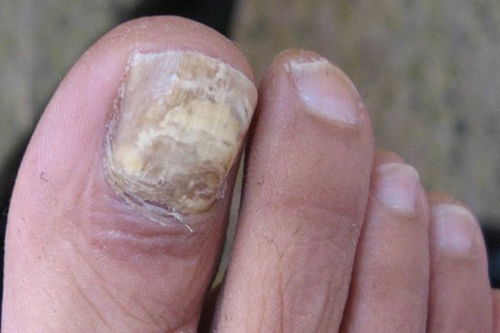 治灰指甲该远离哪些误区 治灰指甲该远离哪些误区