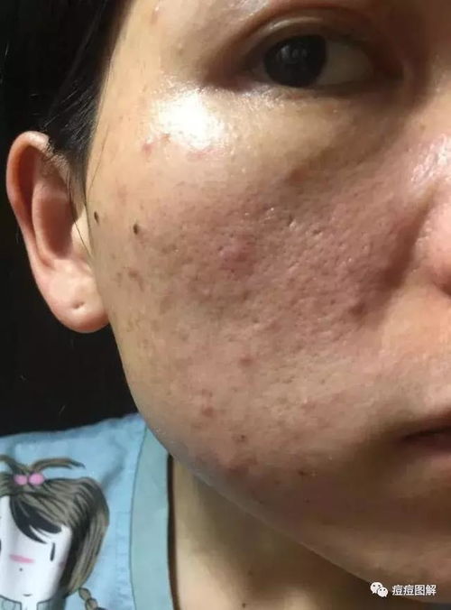 导致灰指甲难以治愈的原因是什么 导致灰指甲难以治愈的原因是什么