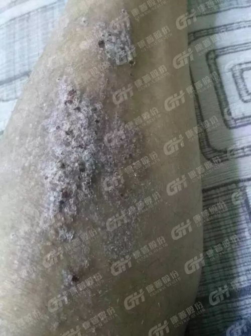 冬季湿疹的治疗方法有哪些 冬季湿疹的治疗方法有哪些