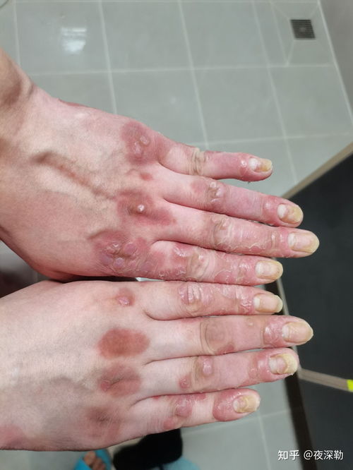 下嘴唇发麻什么病兆 下嘴唇发麻什么病兆