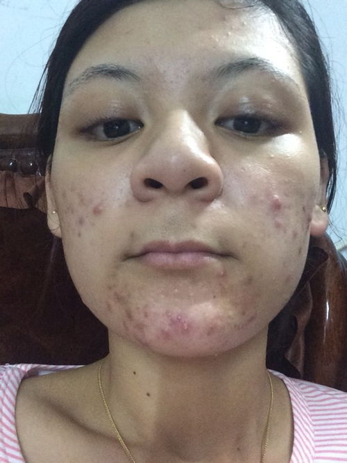 可怜天下父母心 婴儿湿疹的症状 可怜天下父母心 婴儿湿疹的症状