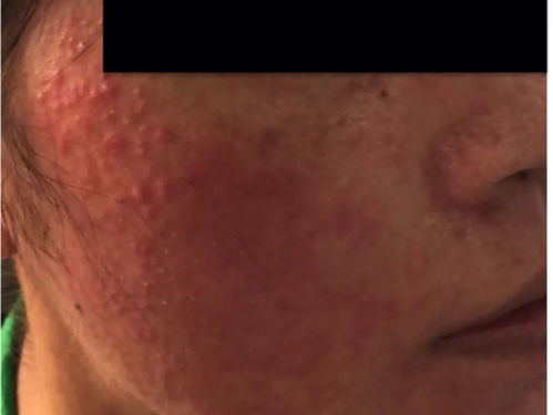 湿疹怎么治能去根偏方(湿疹怎么治能去根) 湿疹怎么治能去根偏方(湿疹怎么治能去根)